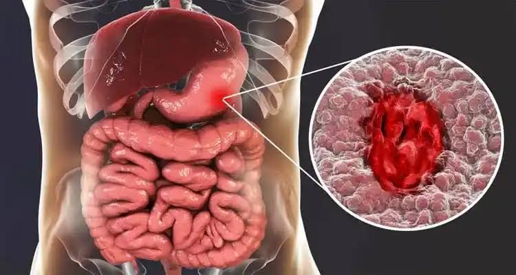 زخم معده چیست و چگونه درمان می‌شود؟